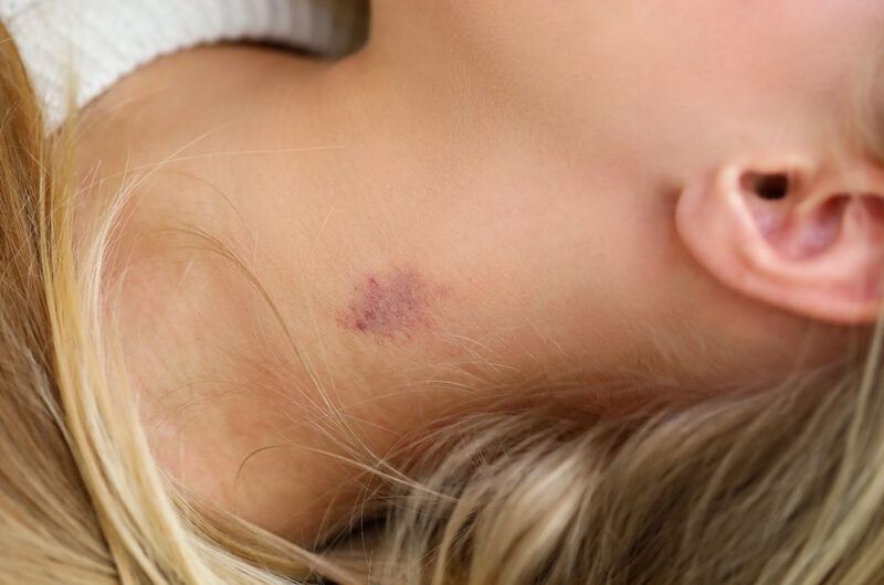 Jak usunąć malinkę? 8 szybkich sposobów